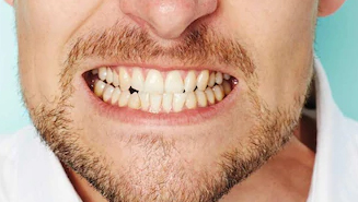 Bruksizm (Diş Sıkma)